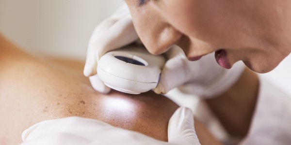 skin cancer skin cancer